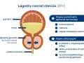 Ilustracja pokazuje łagodny rozrost stercza (BPH) i jego objawy. Prostata, czyli gruczoł krokowy, powiększa się, uciskając cewkę moczową.