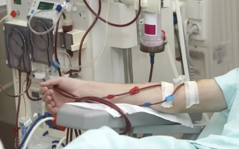 Ramię pacjenta podłączone do maszyny do dializy. Czerwone wężyki prowadzą krew do aparatu, który oczyszcza ją podczas dializy.