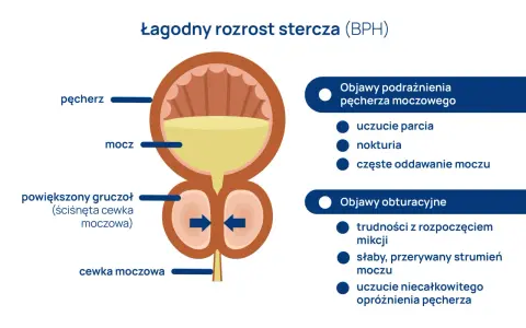 Ilustracja pokazuje łagodny rozrost stercza (BPH) i jego objawy. Prostata, czyli gruczoł krokowy, powiększa się, uciskając cewkę moczową.