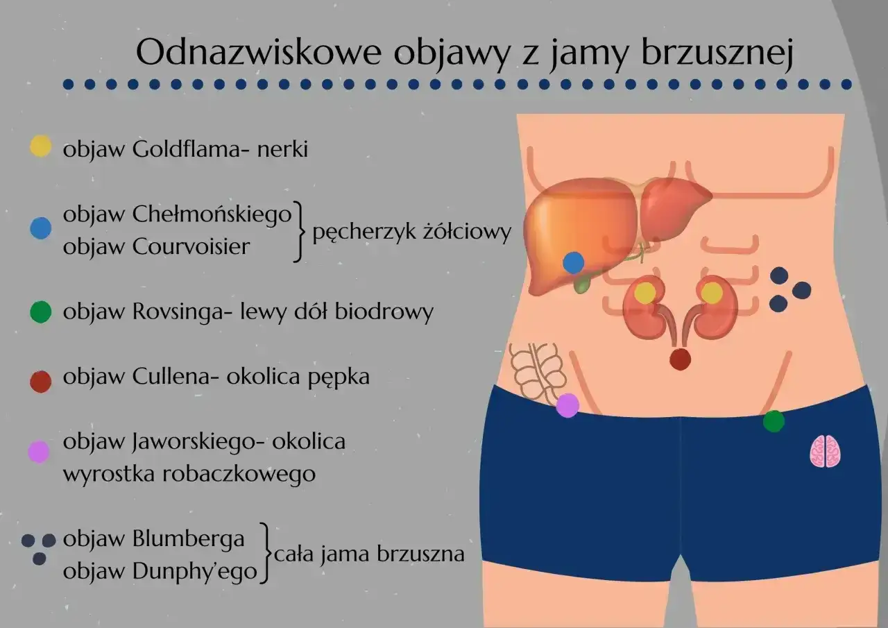 Rysunek przedstawia lokalizację objawu Jaworskiego w okolicy wyrostka robaczkowego, jednego z objawów brzusznych.