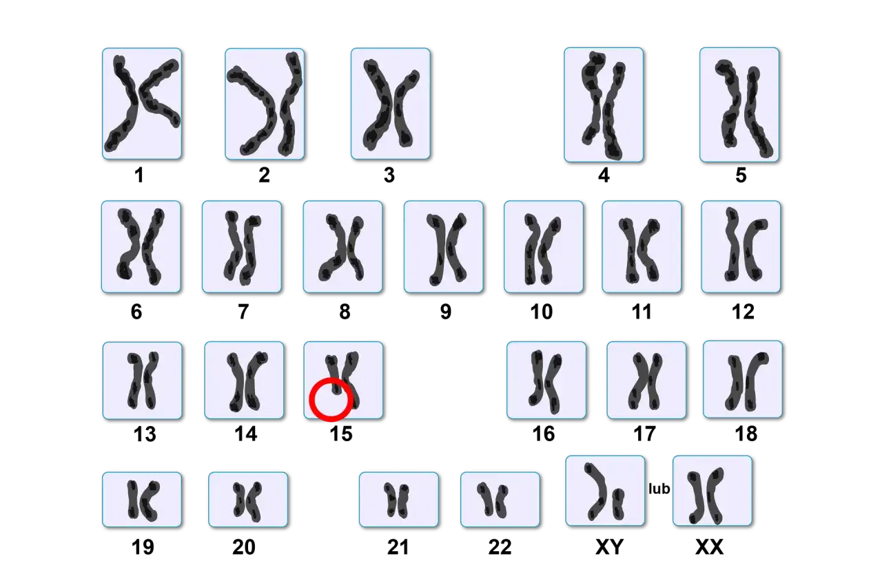 Kariotyp przedstawia uporządkowane pary chromosomów od 1 do 22, a także chromosomy płci XX. Widoczny jest jeden dodatkowy chromosom 15.
