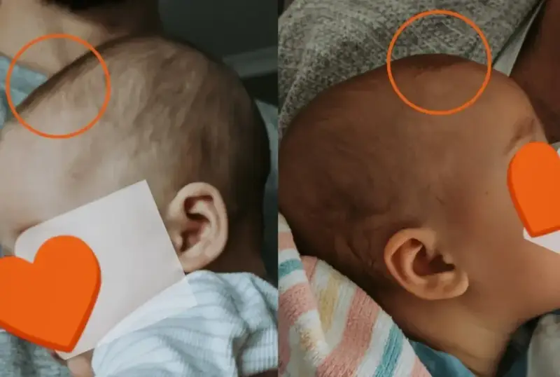 Dwa ujęcia główki niemowlaka. Na pierwszym widać delikatne nierówności na ciemiączku, na drugim ciemiączko jest gładkie.